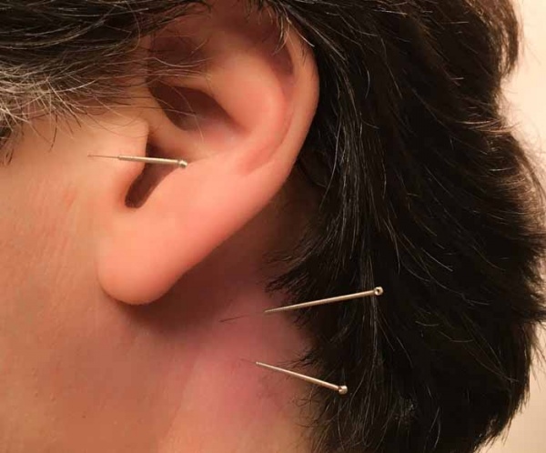 宫玉针炙诊所GONG YU ACUPUNTURE & HERBS CLINIC
